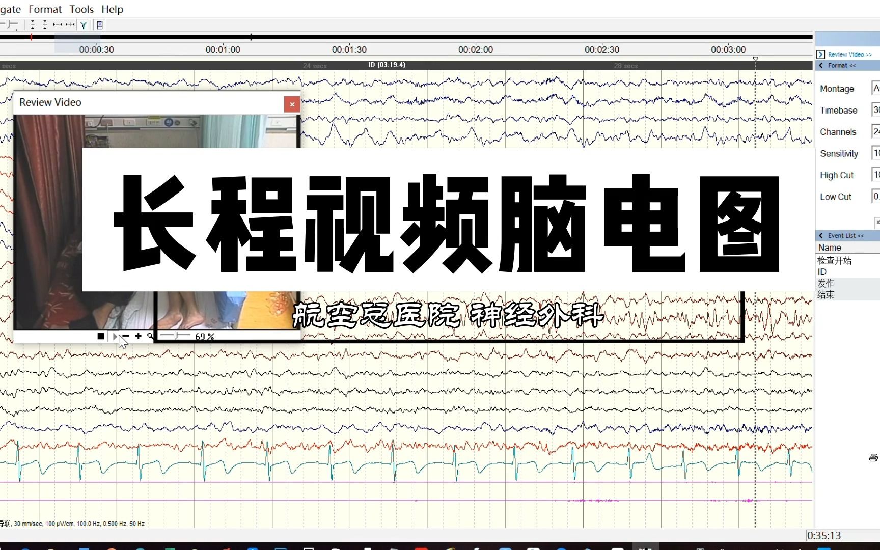 在长程视频脑电图下,可清晰看到癫痫发作与大脑异常放电的对应关系哔哩哔哩bilibili