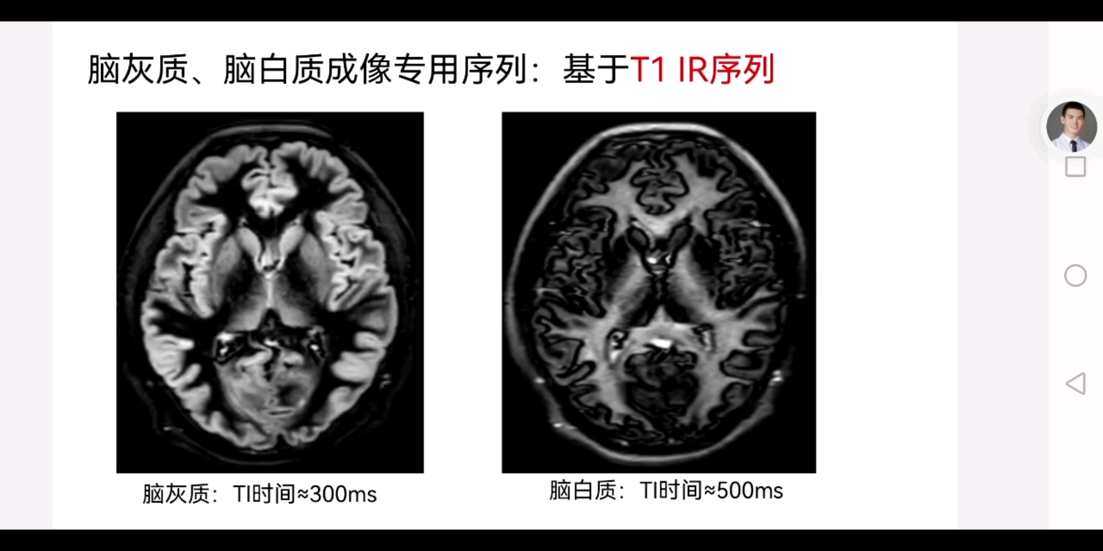 T1 FLAIR有什么作用?与T2 FLAIR有何区别?哔哩哔哩bilibili