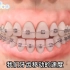 牙齿矫正需要多久？