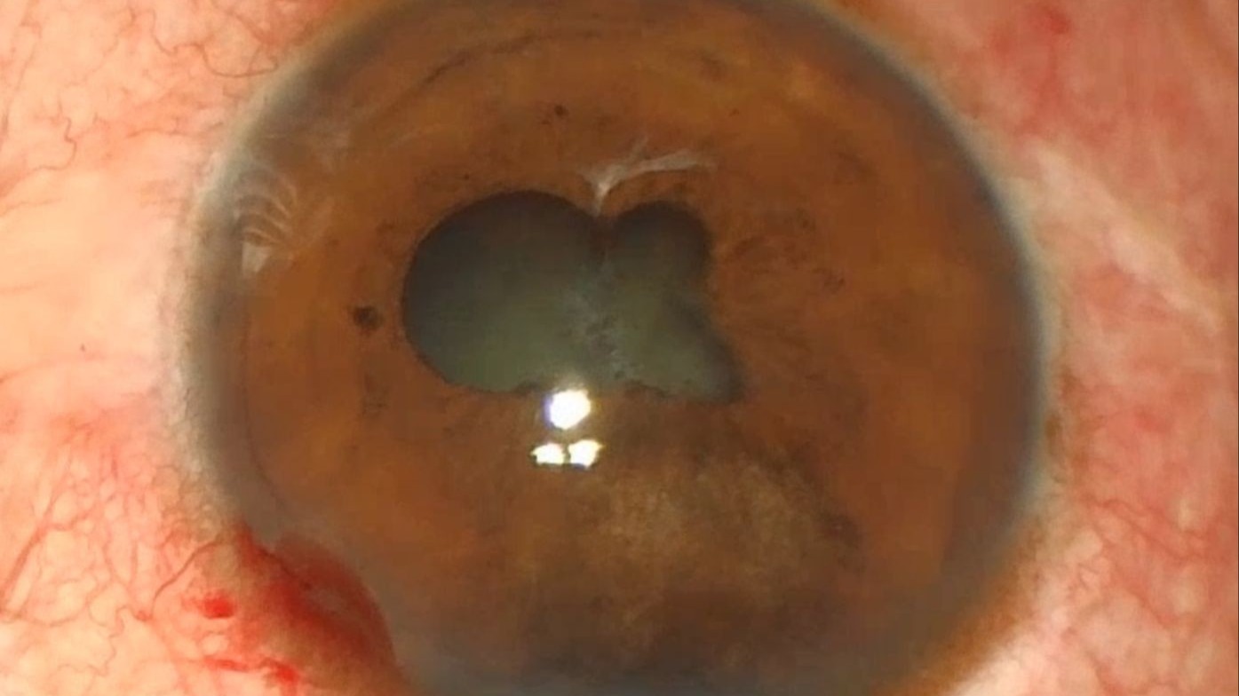 白内障超乳手术实录 欣赏高手如何处理瞳孔粘连,虹膜离断,晶体脱位的