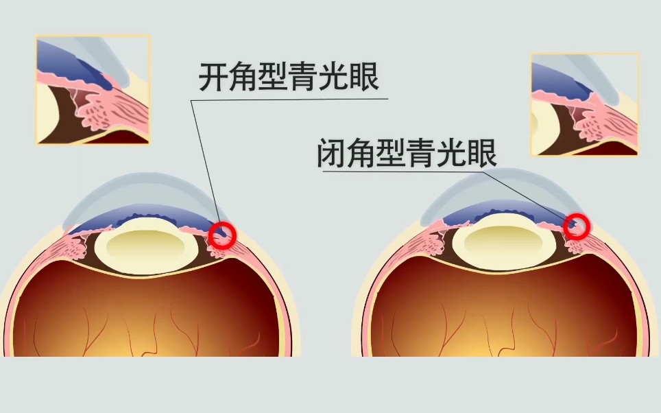 如果眼前出现这些东西,可能是青光眼【湛江爱尔奥理德】