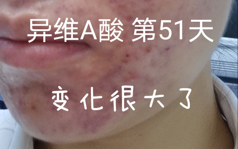 吃异维a酸50天啦距离上次就医变化明显12天后的复诊记录