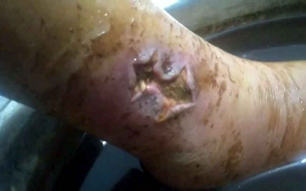 五步蛇咬伤太可怕了,一旦处理不好伤口就会烂肉,搞不好还会被截肢!