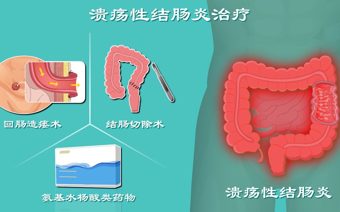 溃疡性结肠炎4:疯狂拉稀该咋治?哔哩哔哩bilibili