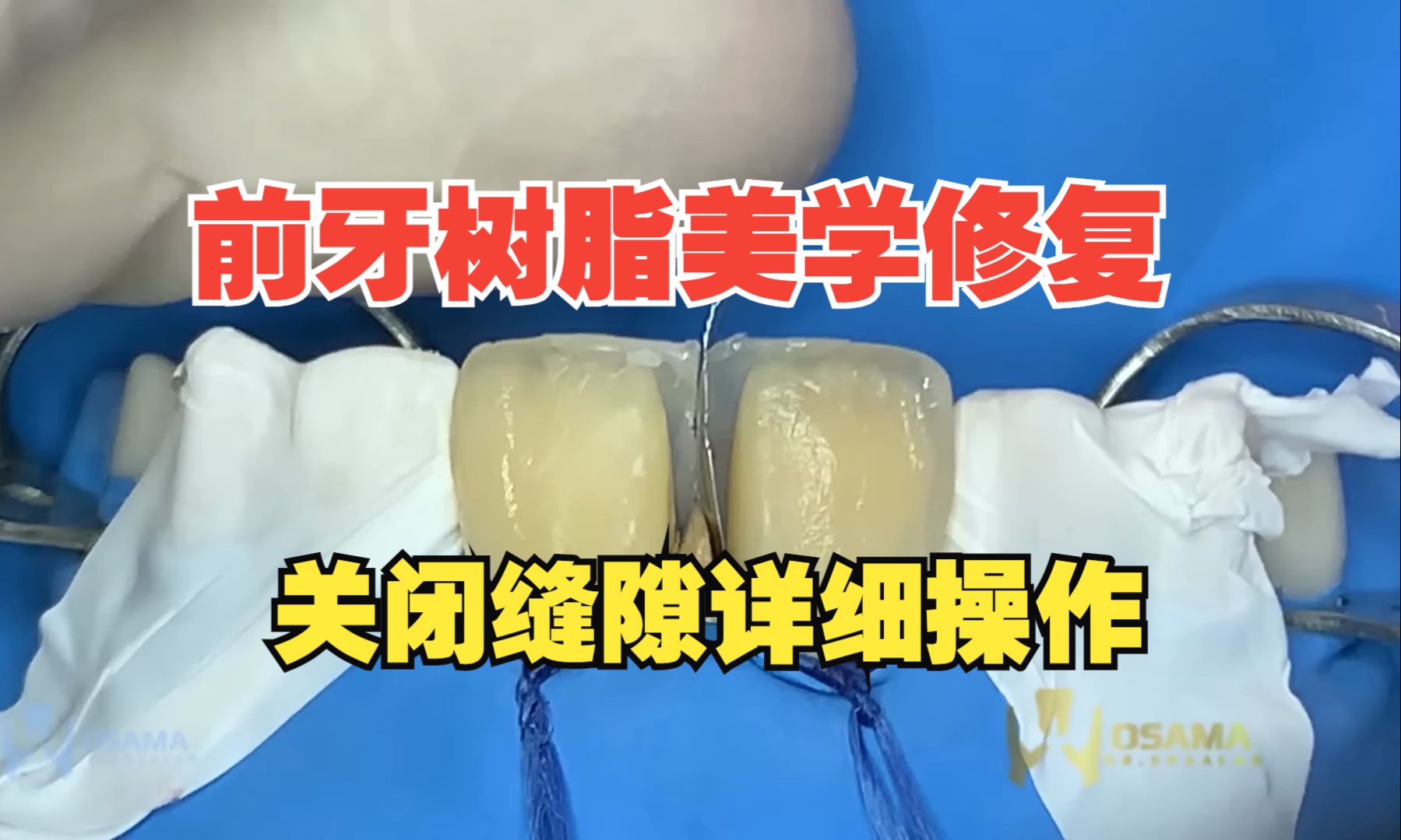 [图]前牙树脂美学修复关闭缝隙。diastema closure with composite resin