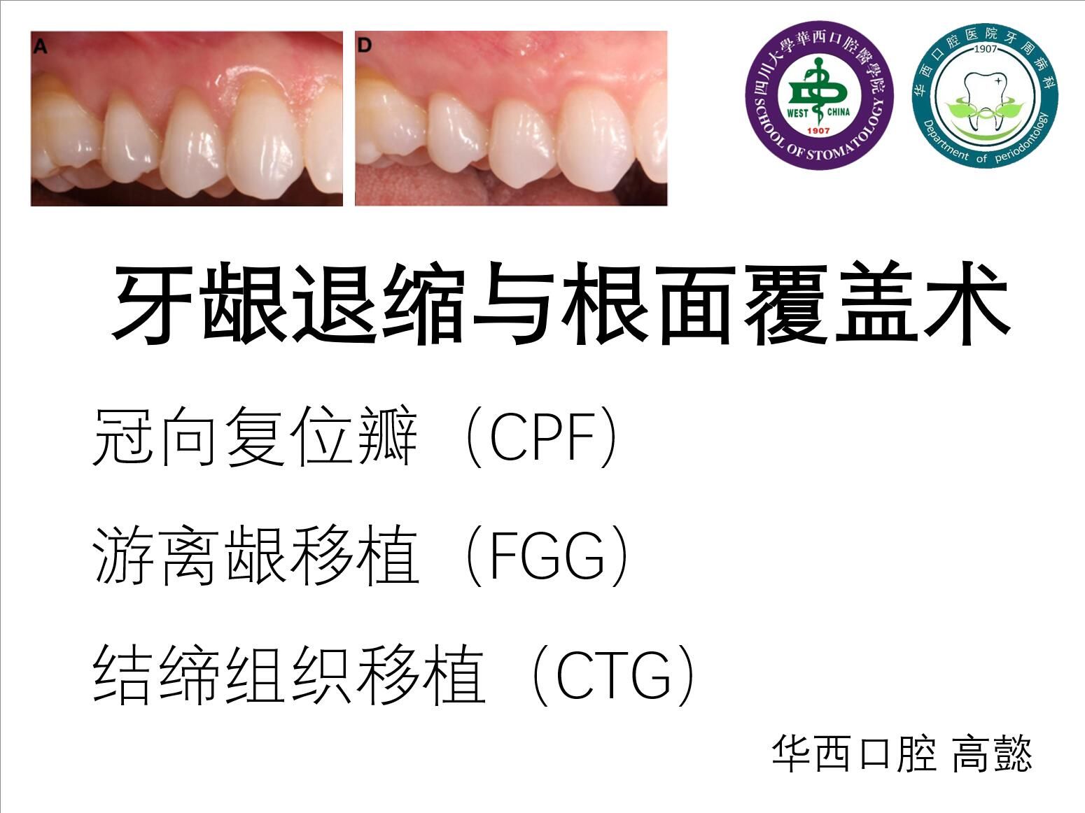 牙龈退缩与根面覆盖术(冠向复位瓣、游离龈移植、结缔组织移植)哔哩哔哩bilibili