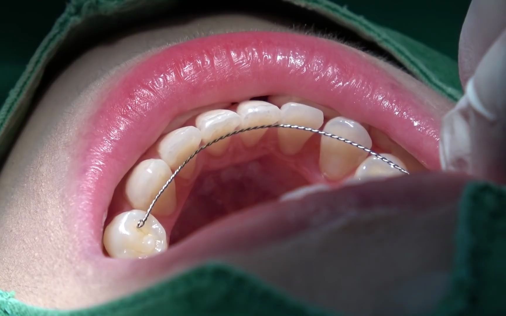 戴保持器 也是牙齿矫正的一部分!