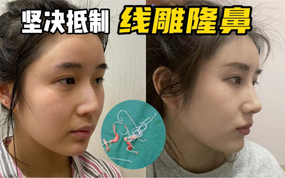 女生从鼻子里取出20多根线线雕鼻建议别碰