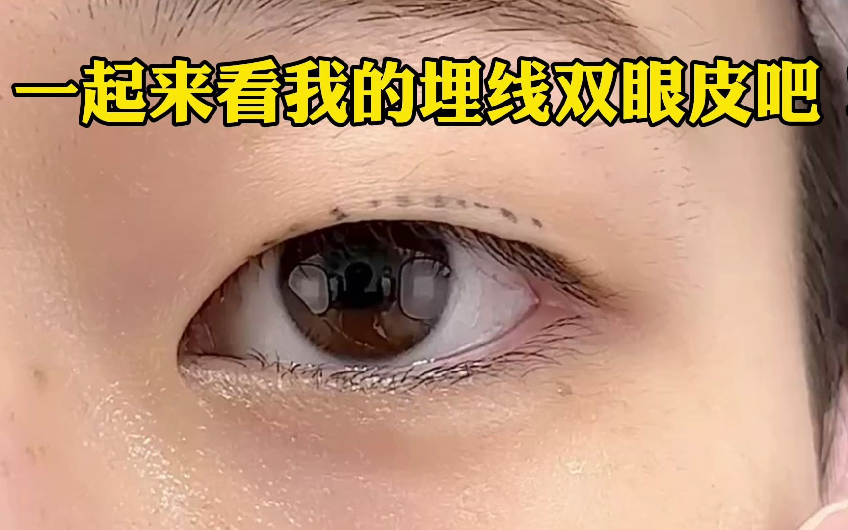 一起来看看我的埋线双眼皮吧哔哩哔哩bilibili