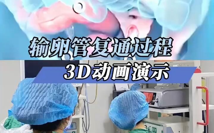 输卵管复通过程3D演示哔哩哔哩bilibili