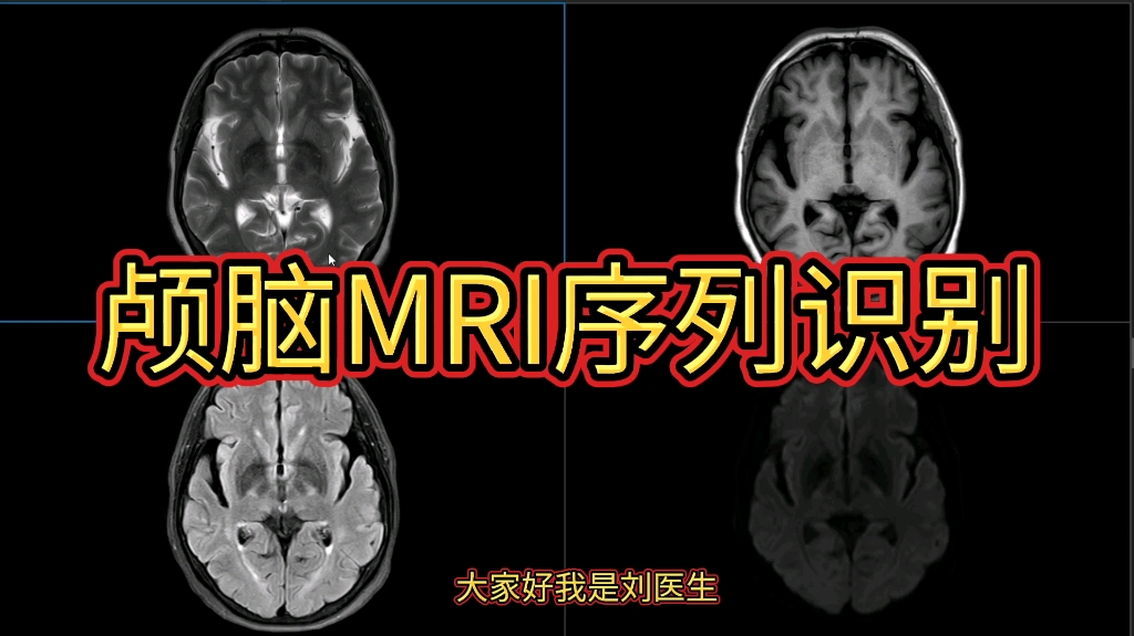 颅脑MRI基础:如何区分各序列MRI图像?医生讲解,初学者必看!哔哩哔哩bilibili