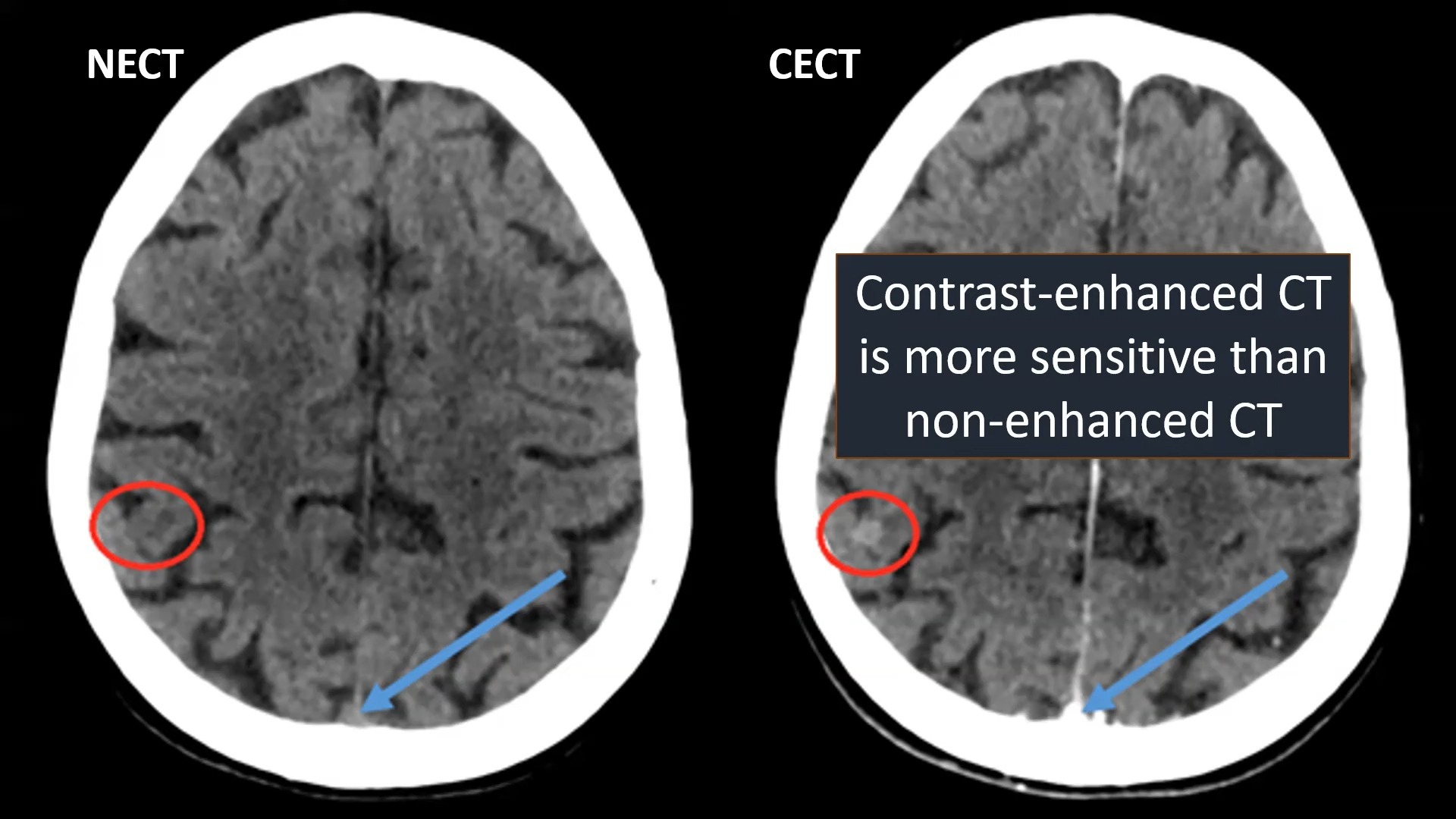 脑转移imaging of cerebral metastases