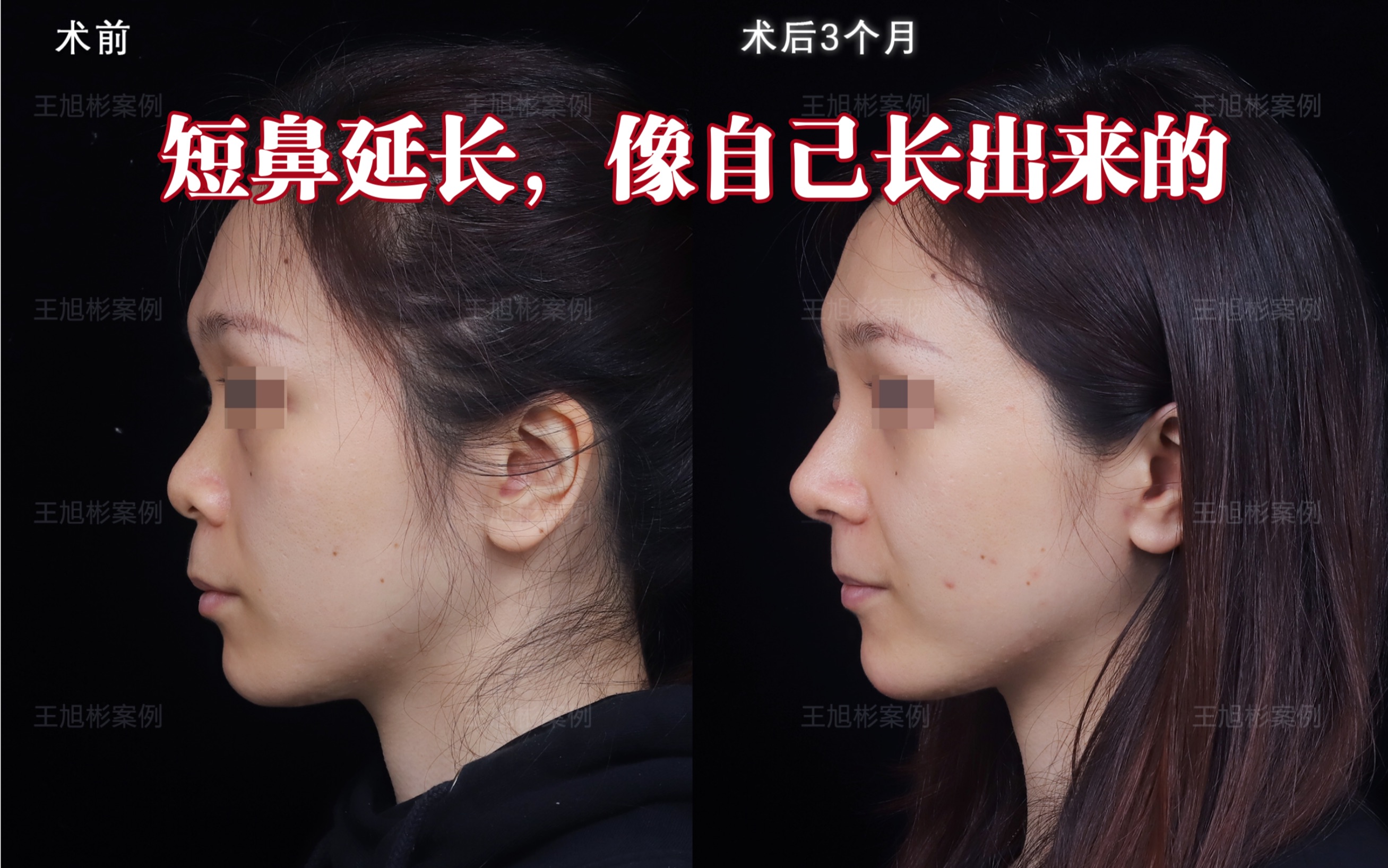 短鼻延长3个月,鼻子跟自己长出来的一样!