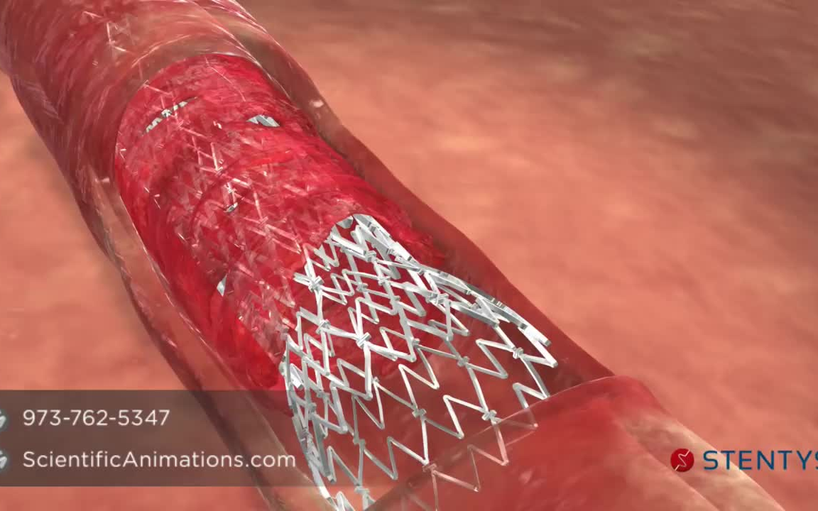 【医学动画】冠状动脉支架手术哔哩哔哩bilibili