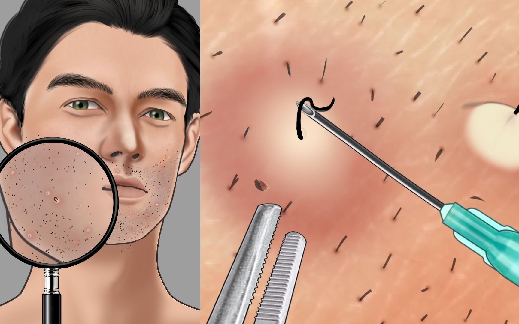 超解压毛囊清理,大叔一秒变男神!_哔哩哔哩_bilibili