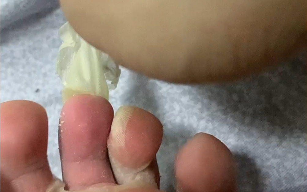 得了丹毒之后,我的脚趾就跟守宫蜕皮一样