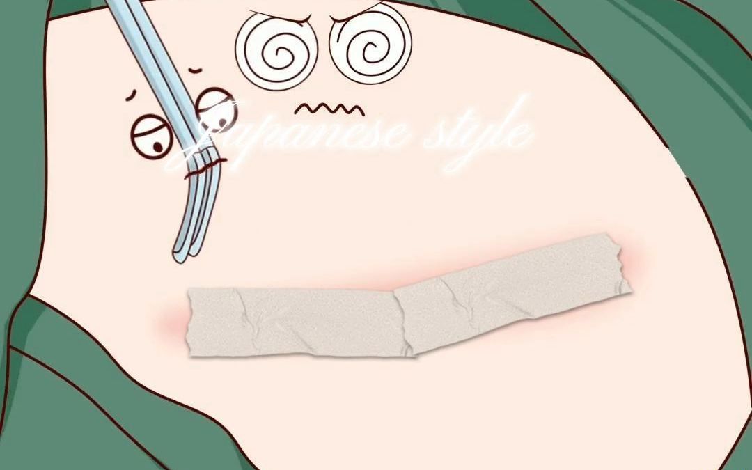剖腹产动画演示,这也是多数人做腹壁整形修复的起源