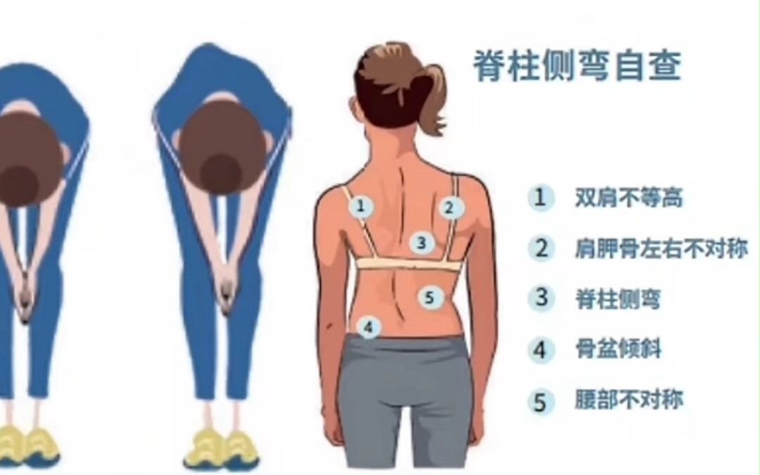 青少年脊柱侧弯筛查 从0°到40°的变化