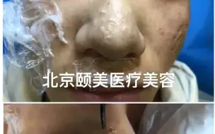 Video herunterladen: 鼻头皮脂腺增生激光定点精准剥脱治疗，一颗一颗做，掌握深度，一次就有明显效果