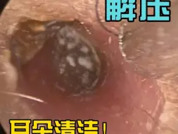 Descargar video: 真菌性外耳道炎清理过程，痂皮抠干净了真爽！