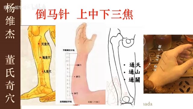 【针灸】 倒马针 (董氏奇穴-杨维杰-40)