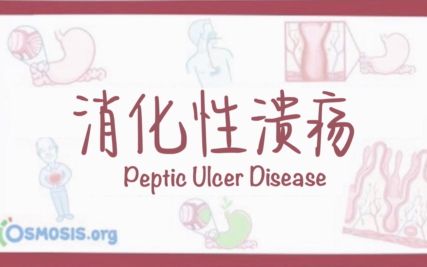 [图][Osmosis]中字 消化性溃疡 科普 Peptic ulcer disease 科普短片搬运+翻译