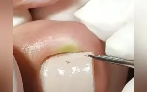 甲沟炎修脚解压