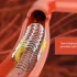 3D演示动脉支架手术
