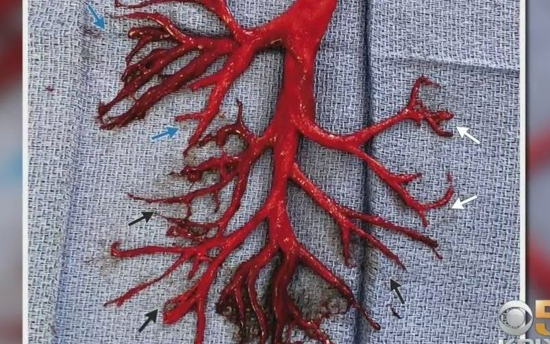 美国男子咳嗽竟咳出支气管树状血块,一周后不幸离世@油兔不二字幕组