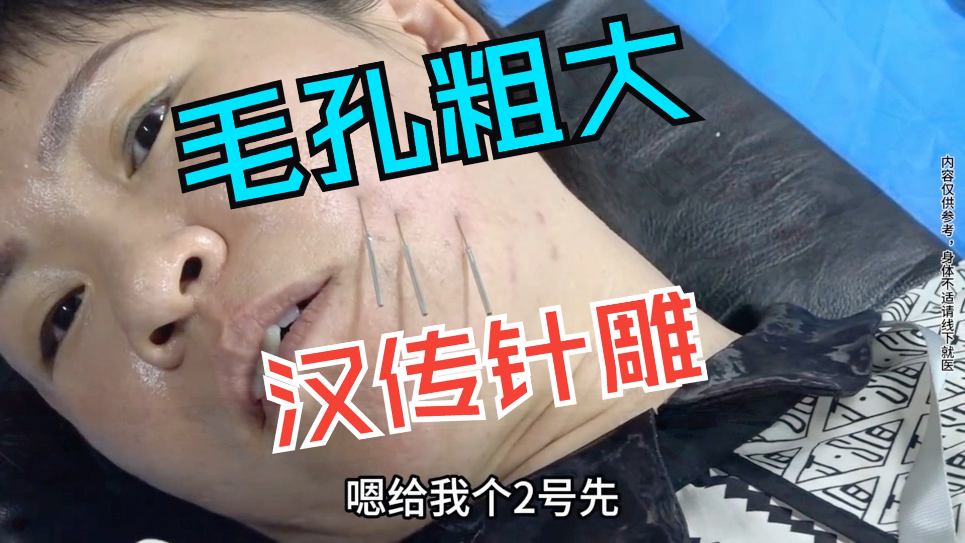 王瑞雪汉传针雕 毛孔粗大,让你皮肤收缩紧致! 美容针灸 私密针灸教学