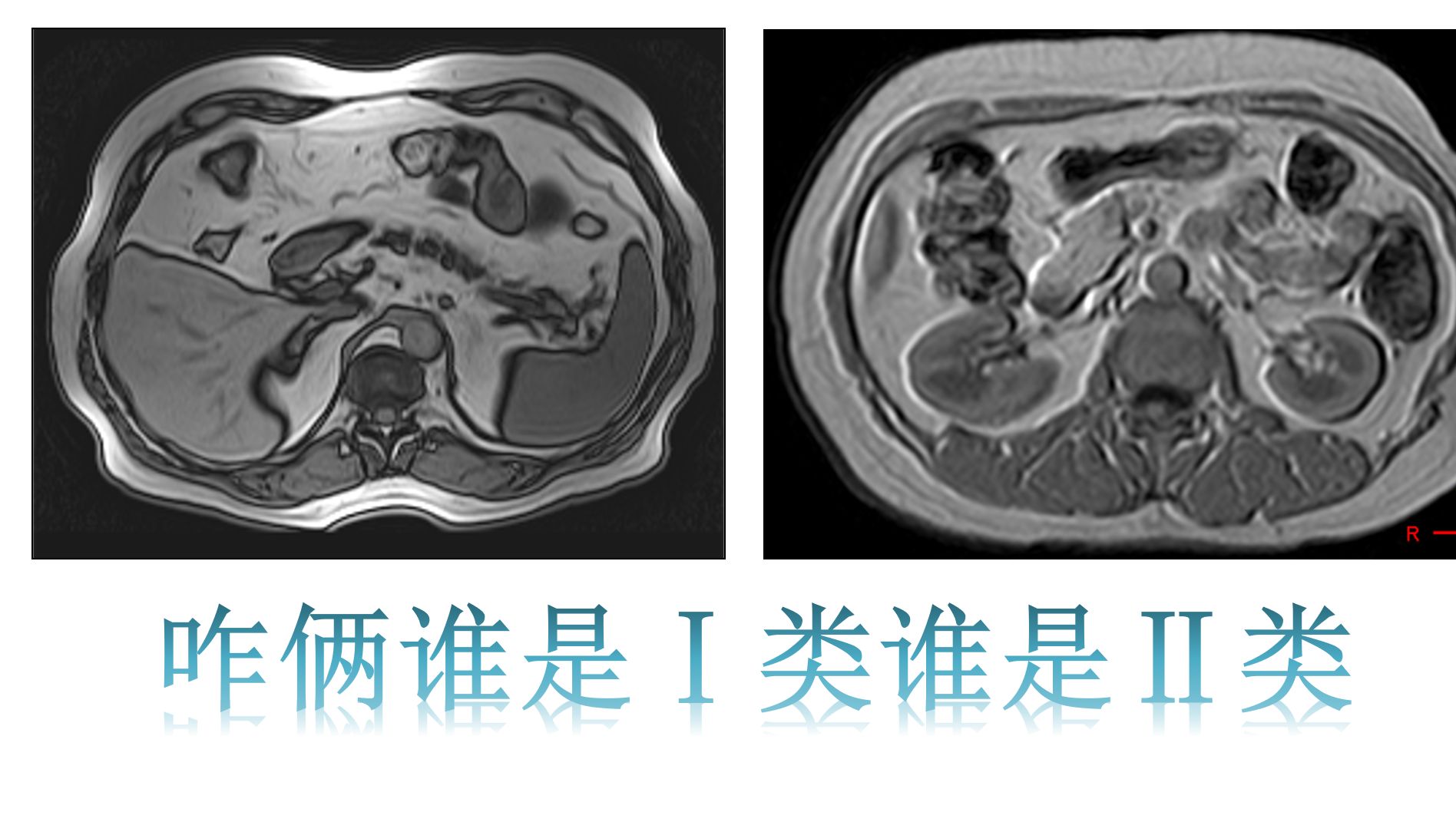 勾边伪影和化学位移伪影区别李懋哔哩哔哩bilibili