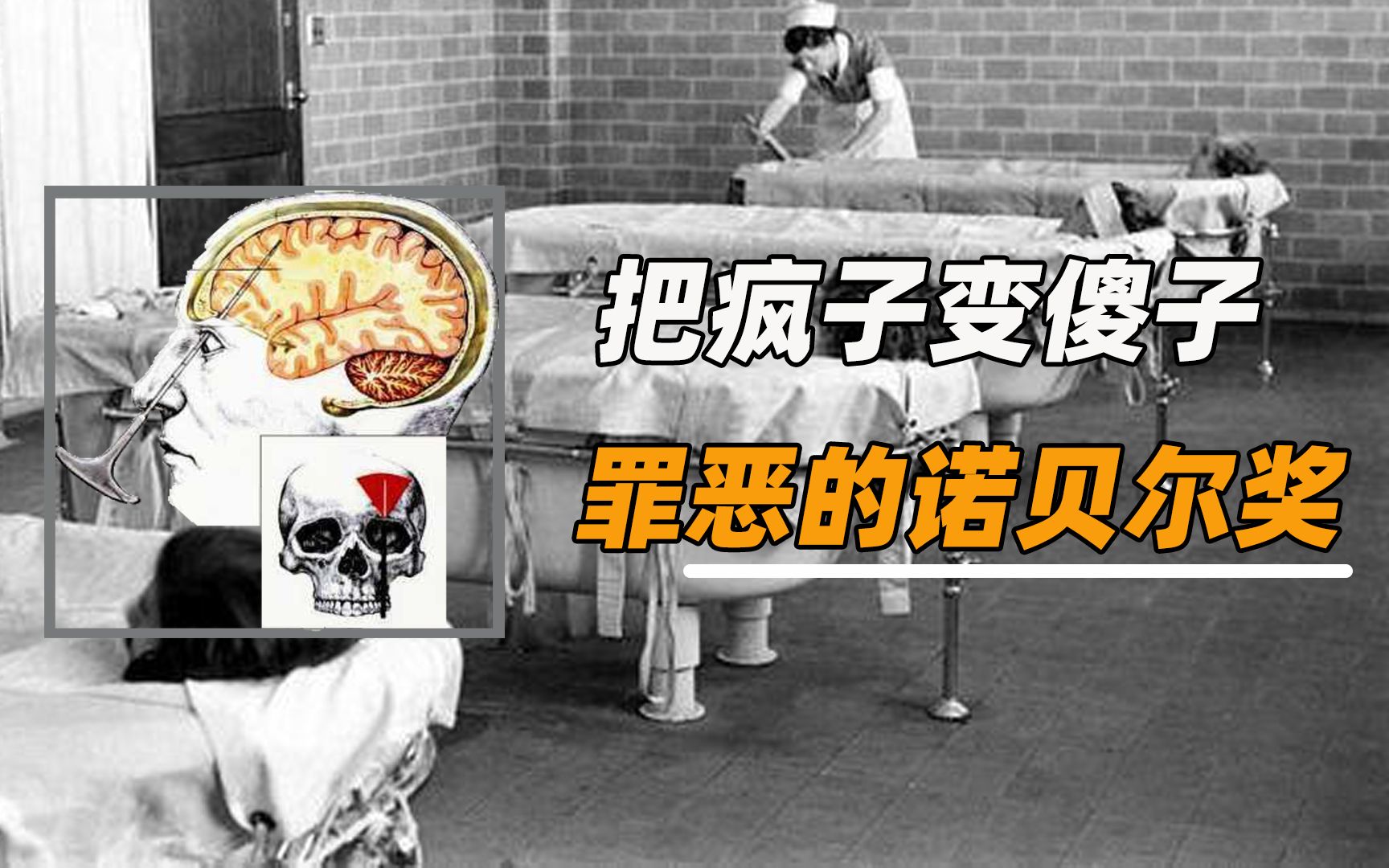 把疯子变傻子的脑前额叶切除术堪称诺贝尔奖的耻辱却受尽追捧