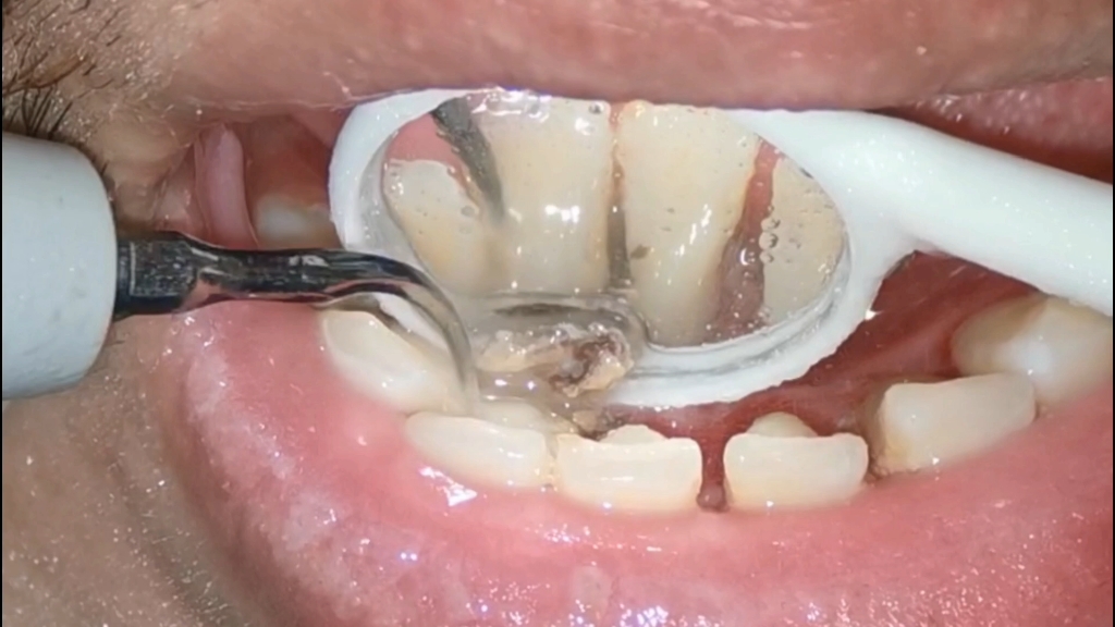 年底了,存了一年的或者几年的牙结石清洗一下