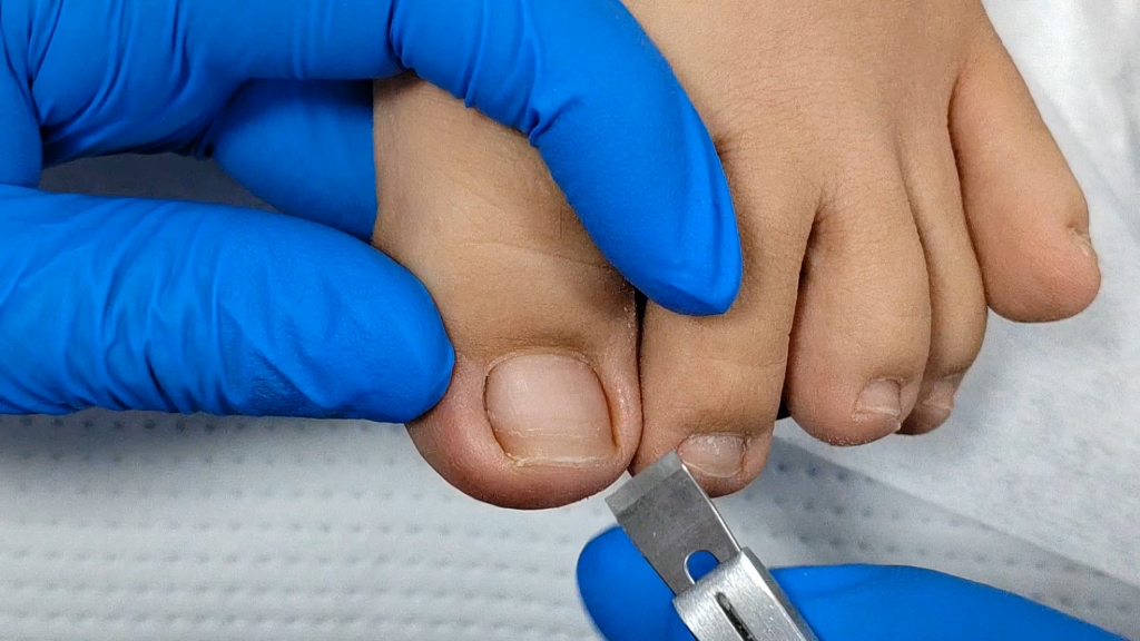 甲沟炎红肿扎肉