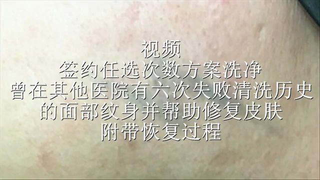 洗纹身视频洗文身辽宁营口洗纹身患者用醋擦让纹身变淡吗皮肤研究所洗