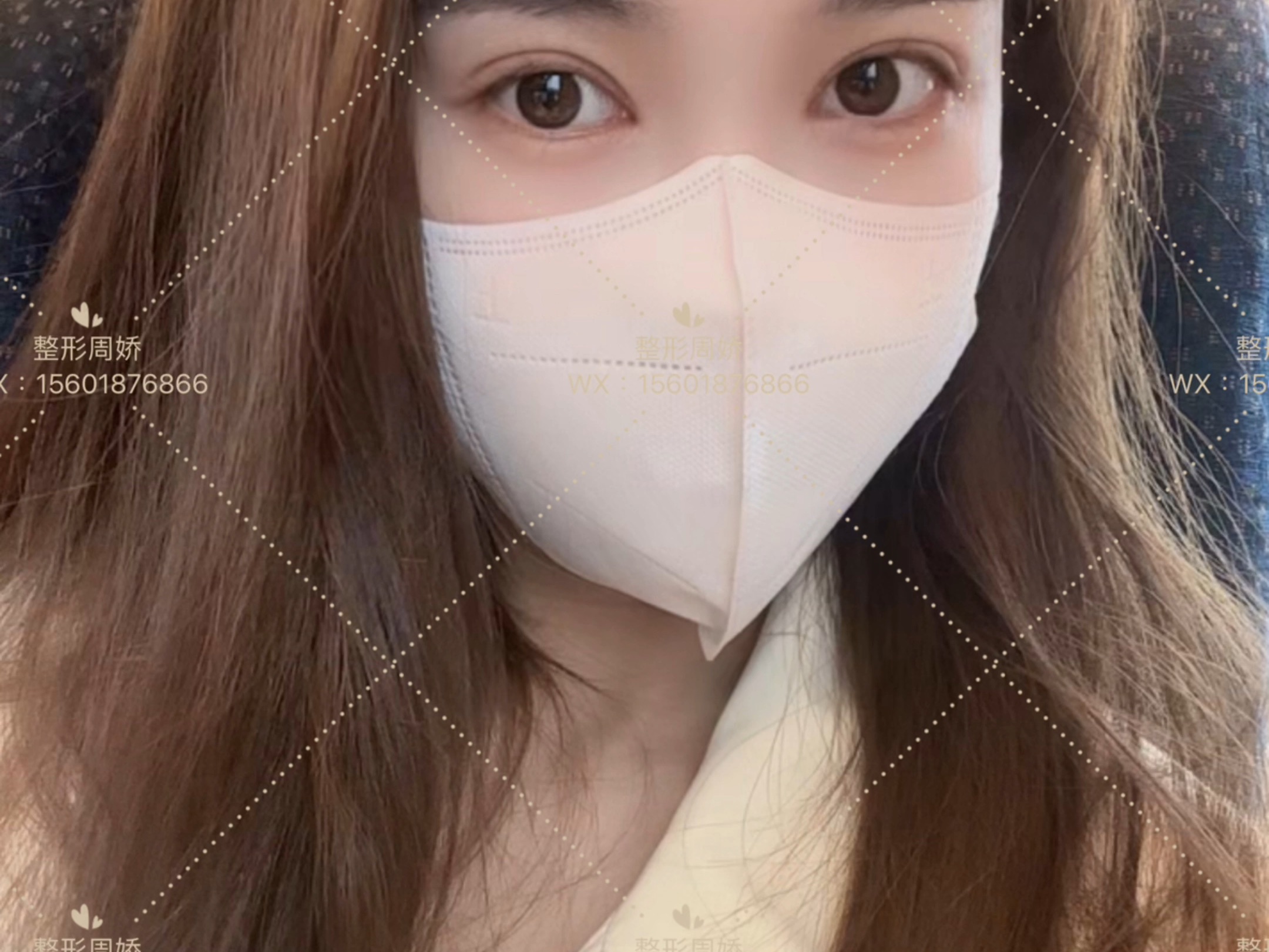 双眼皮77开内眼角术后5个月啦她的闺蜜说她成功上岸