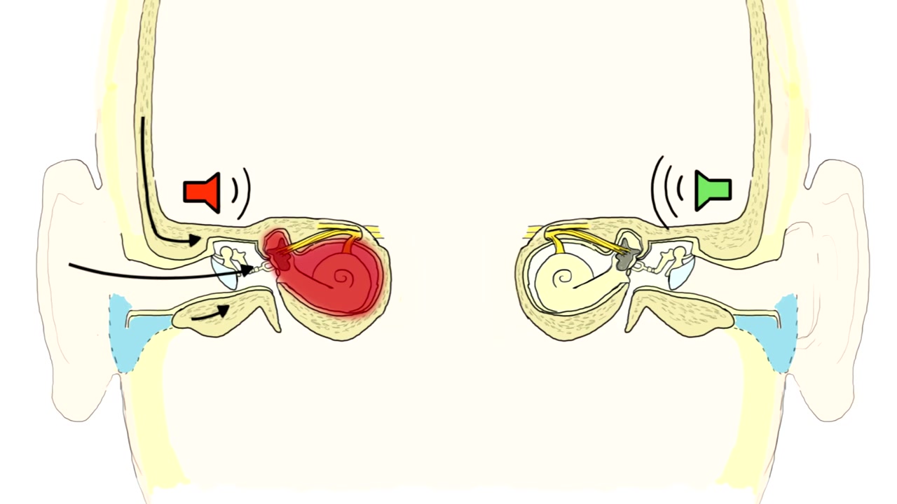 听力检查 Weber and Rinne test  Clinical examination  AMBOSS哔哩哔哩bilibili