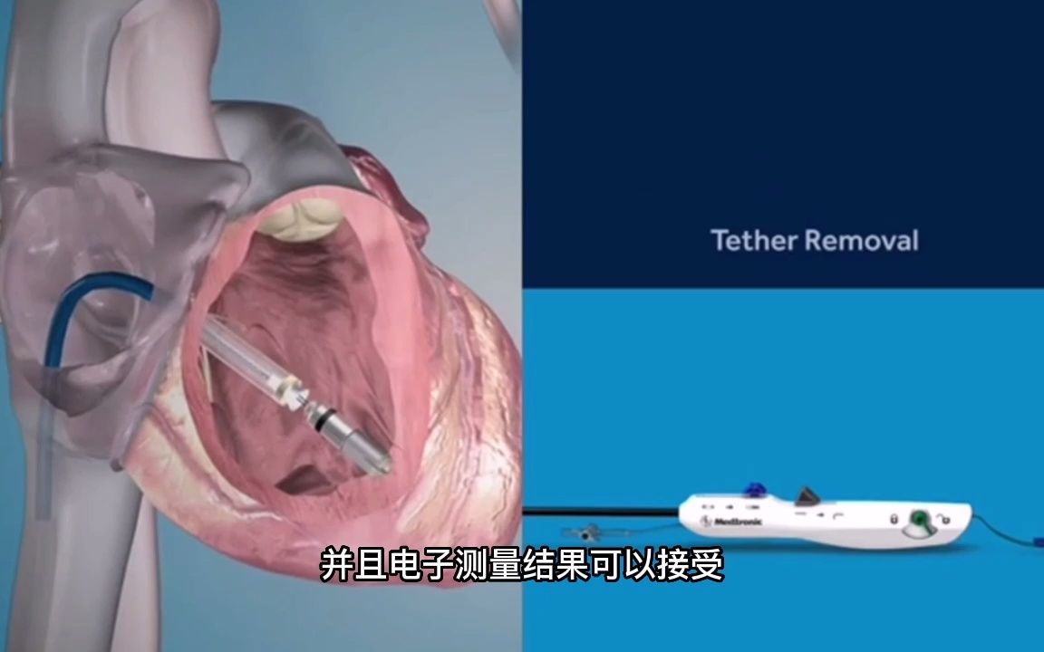 micra tps implant procedure animation | 胶囊起搏器植入操作 有声