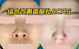 Video herunterladen: 综合改善露鼻孔ACRS 1.鼻翼缘矫正 2.鼻槛上提 3.鼻小柱缩短  三方面综合改善露鼻孔