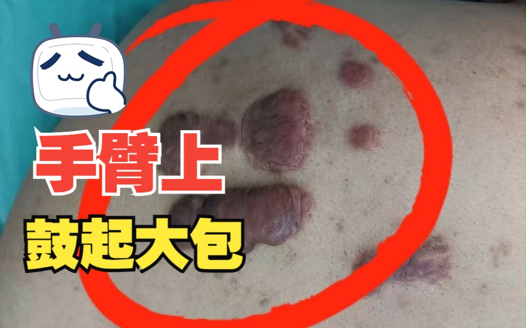 手臂上鼓起大包瘢痕疙瘩持续长大