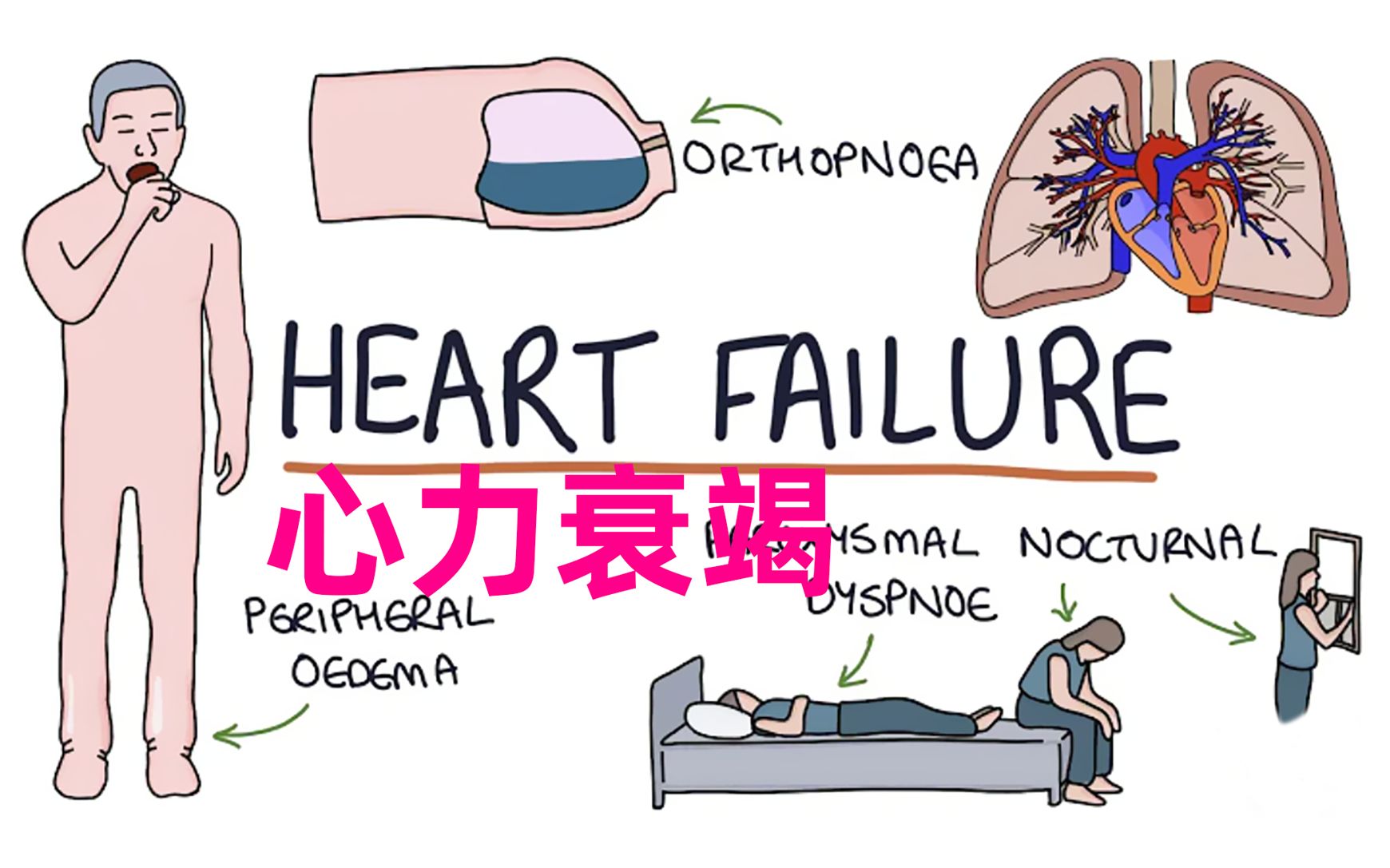 [图]心力衰竭 | 了解心衰 Understanding Heart Failure【搬运自译】【中英双字】