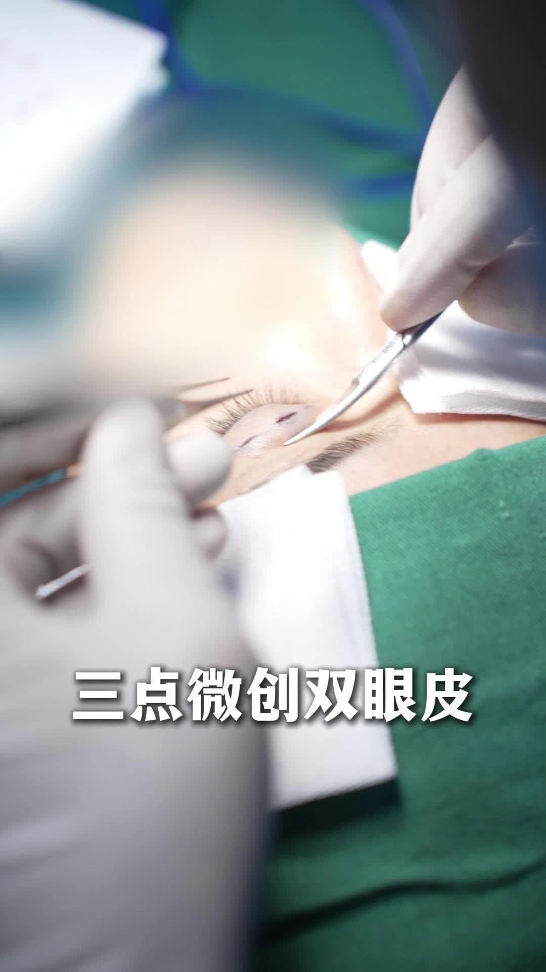 三点微创双眼皮