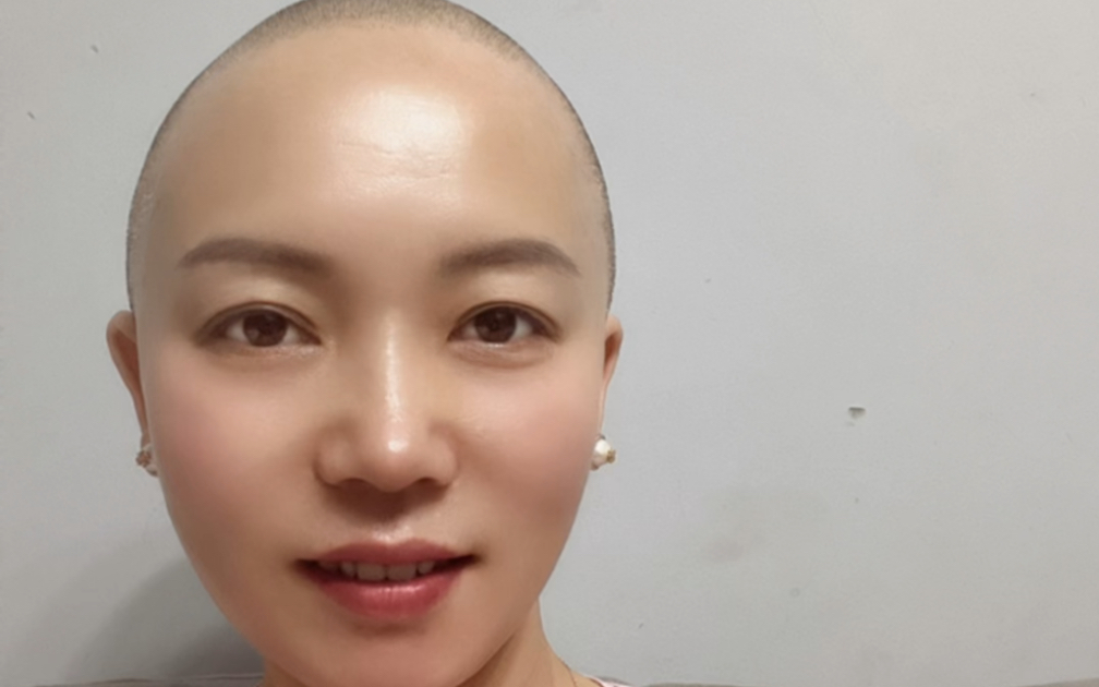 剃光头养发第27天一起见证白发改变09