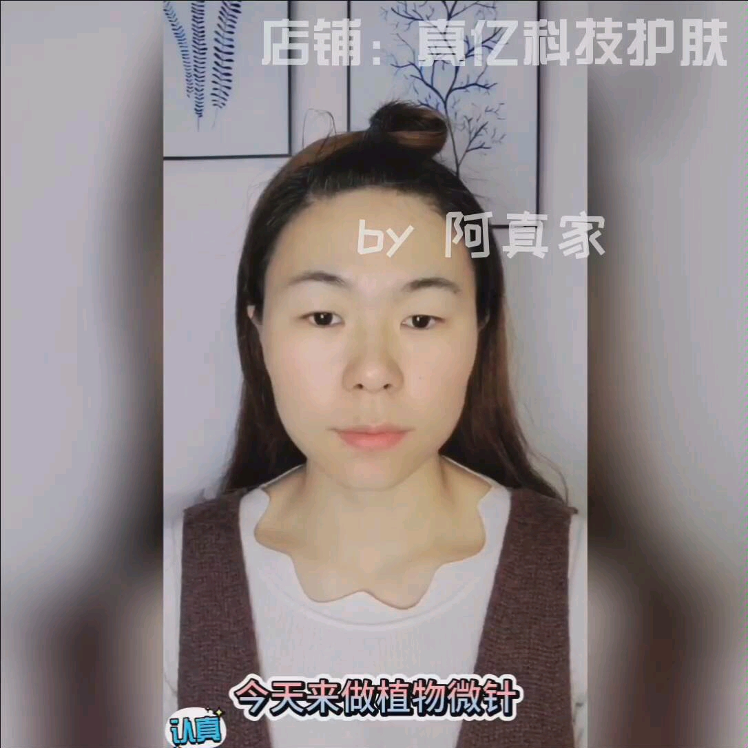 微针操作步骤教学哔哩哔哩bilibili