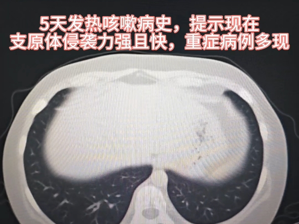 儿童重症支原体肺炎引发并发症之严重肺不张,提示支原体侵袭力增强,重症多现!哔哩哔哩bilibili