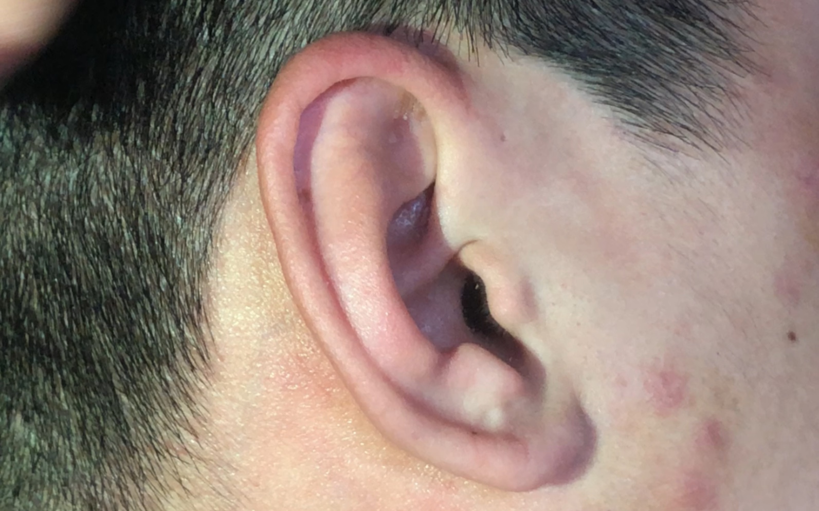 耳朵边缘藓症状图片图片