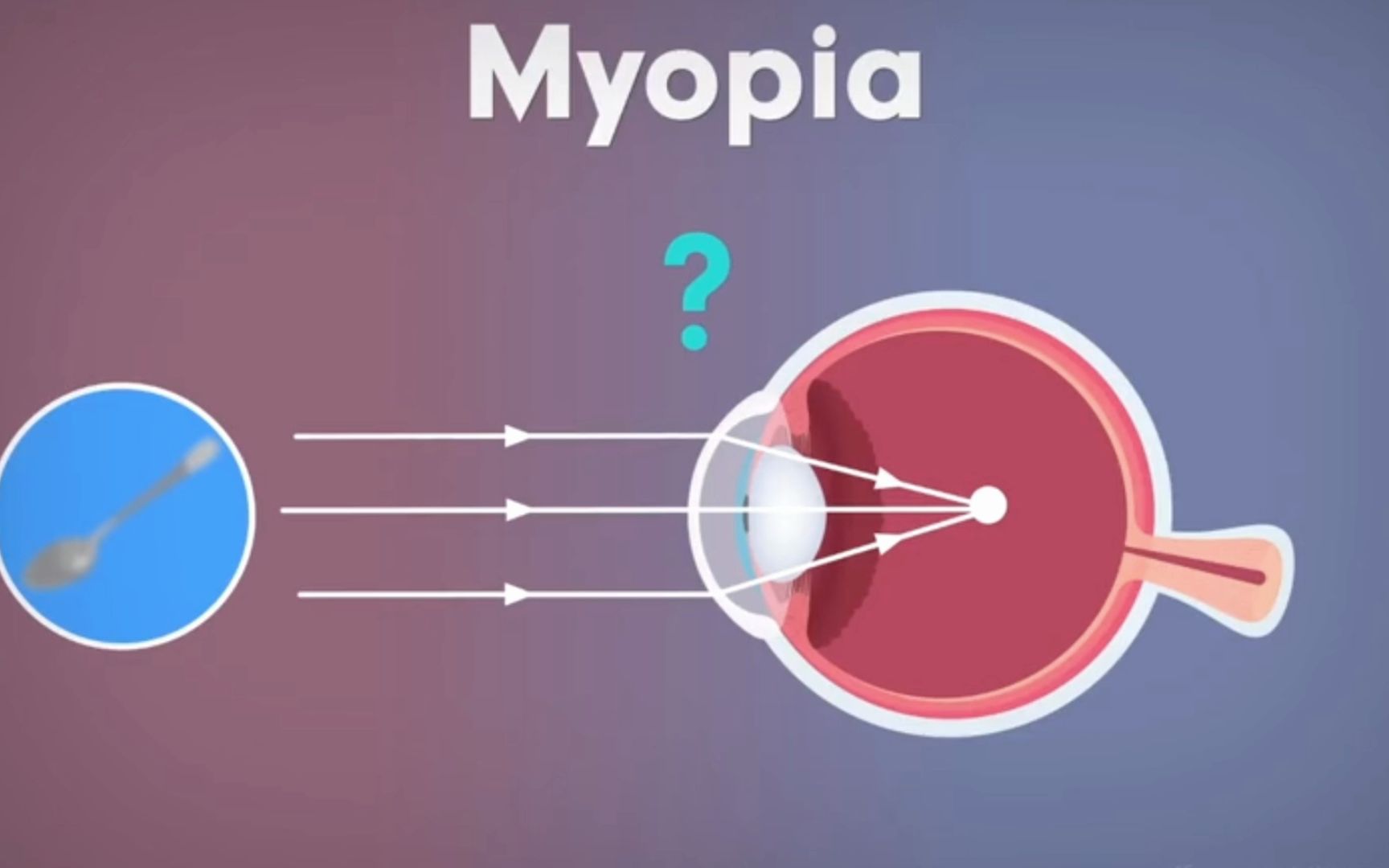 近视眼动画myopia哔哩哔哩bilibili