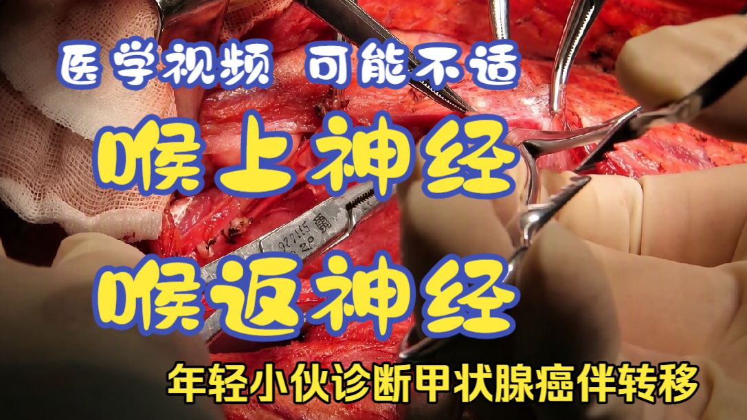 右侧甲状腺右叶+峡部切除+淋巴结清扫(第二部分)