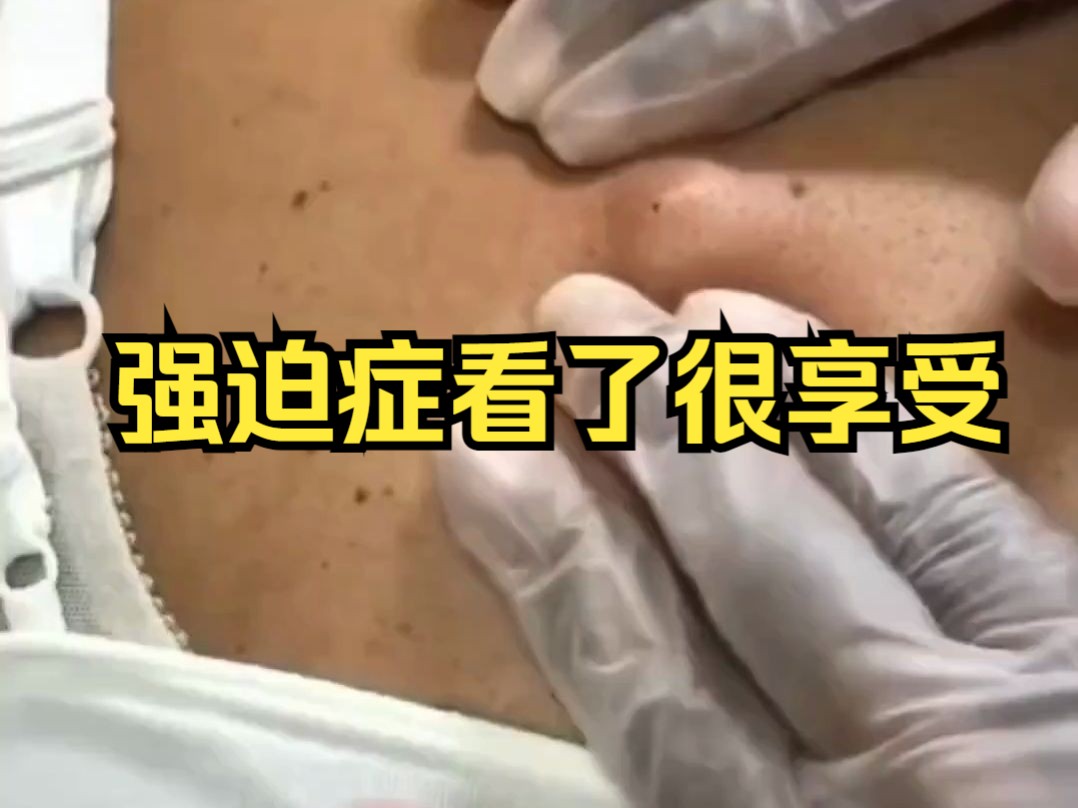 后背的一个大粉刺脓包,挤出来超多存货!哔哩哔哩bilibili