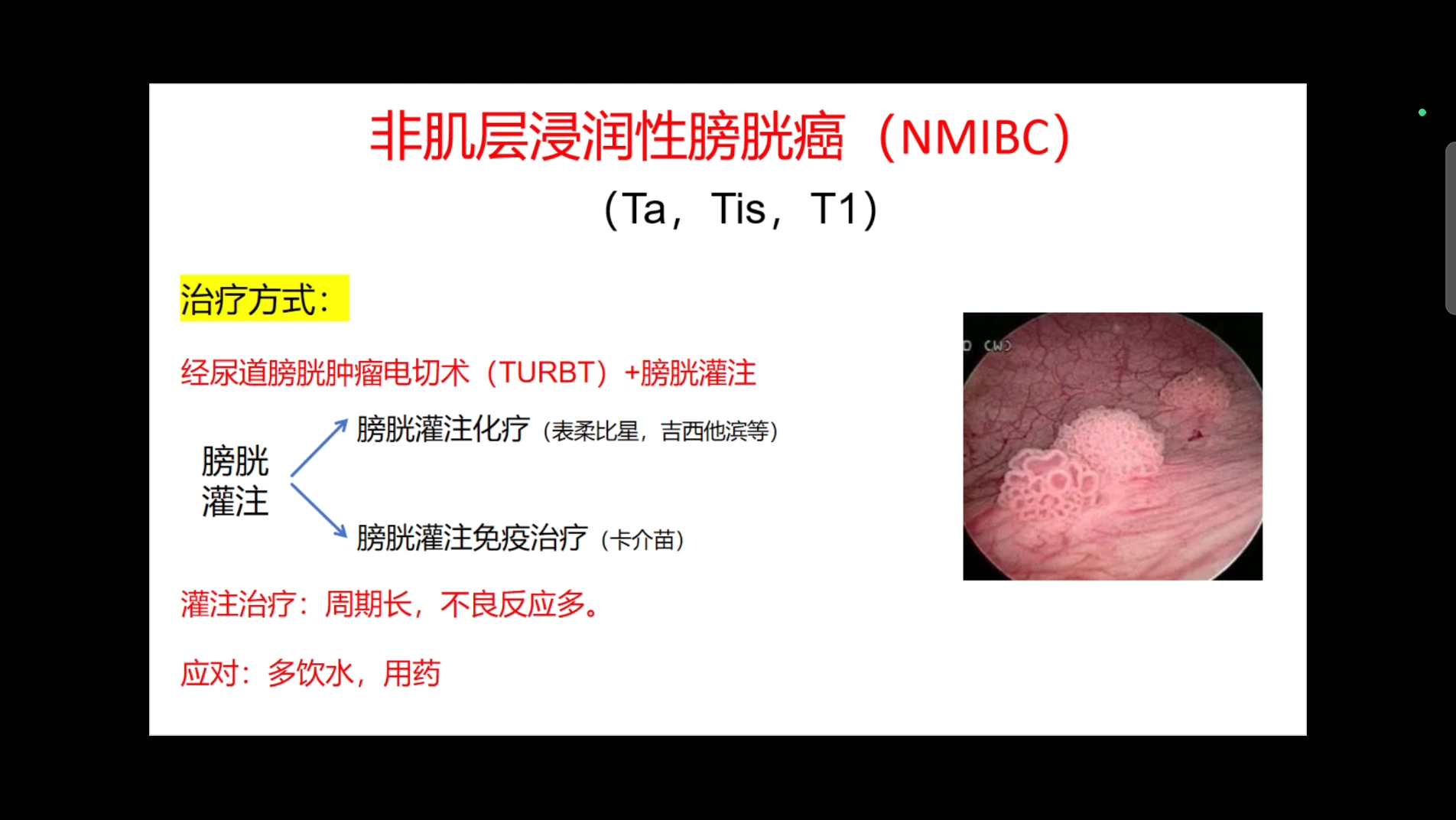 膀胱癌辅助治疗:非肌层浸润性膀胱癌的膀胱灌注治疗哔哩哔哩bilibili